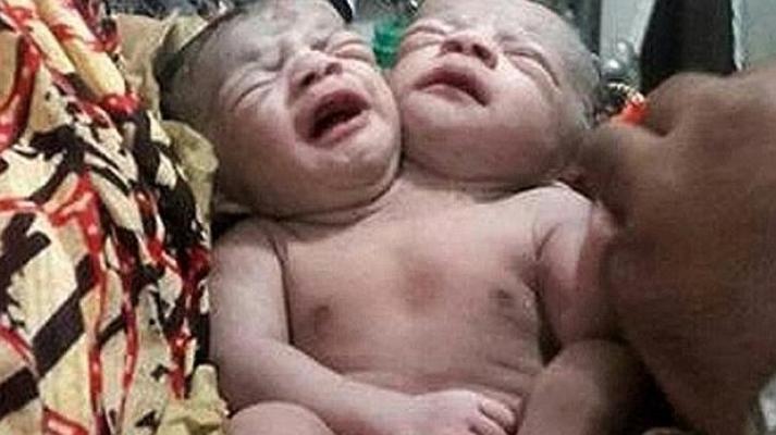 Nació un bebé con dos cabezas en Bangladesh